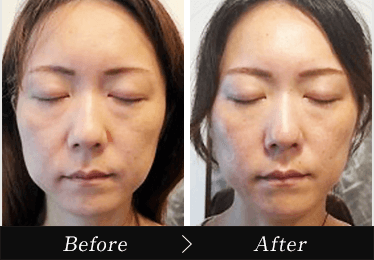 小顔矯正ビフォーアフター1