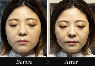 小顔矯正ビフォーアフター2