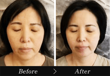 小顔矯正ビフォーアフター3